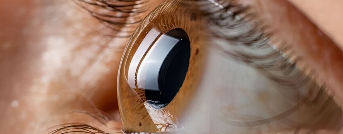 Огляд кератоконусу: історія, етіологія та діагностика