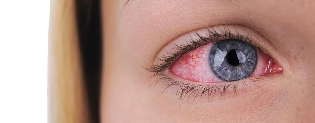 Запалення очей при носінні контактних лінз: як розпізнати, як допомогти собі під час воєнного стану?