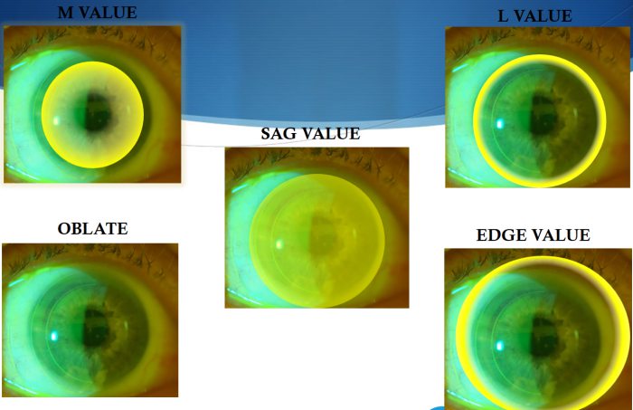 Склеральні лінзи OneFit Med