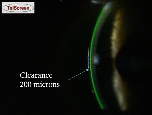 Склеральні лінзи OneFit Med