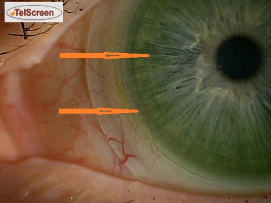 Склеральні лінзи OneFit Med