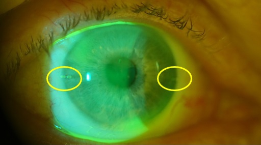 Склеральні лінзи OneFit Med